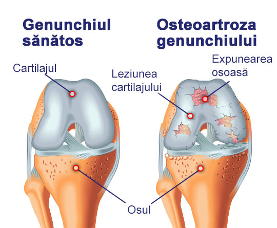 Imaginea anatomică a genunchiului arată cauzele artritei_durerii articulare